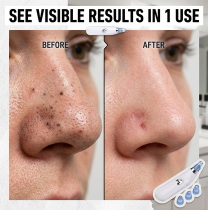 PoreVac blackhead remover
